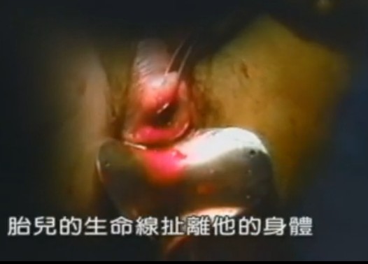 实拍组图:美国堕胎手术全过程【10】--人民网卫