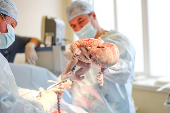 一个生命的诞生!直击剖腹产分娩手术全过程【17】