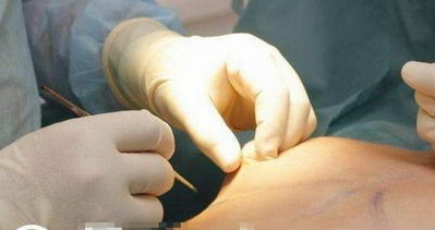 实拍国外美女隆胸手术全程(组图)【8】--科技-