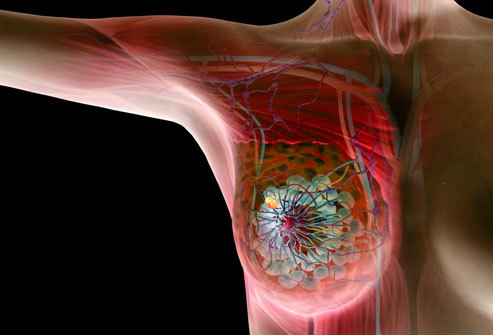 女性乳腺癌早期症状图片展示