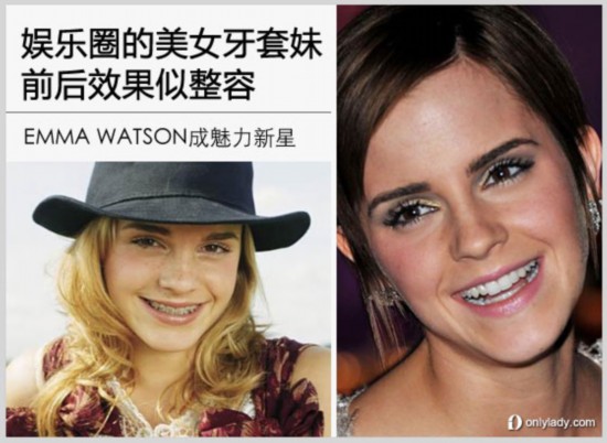 娱乐圈的美女牙套妹 前后效果似整容【2】