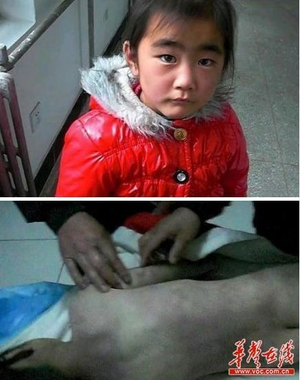 10岁男童遭母亲男友残忍剁手 图揭近年残忍虐