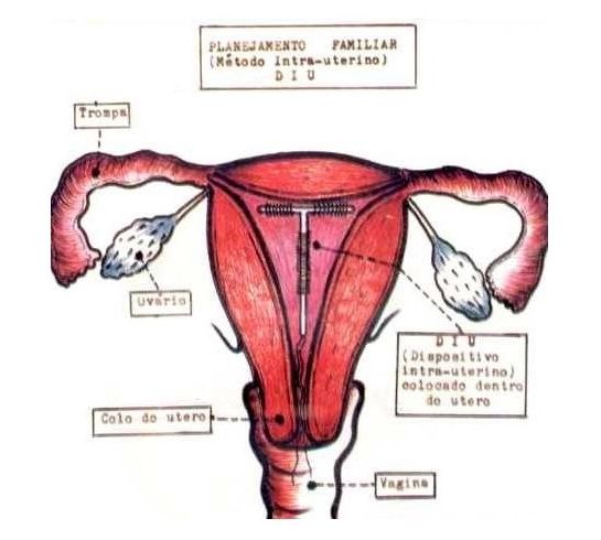 最简单长效的避孕方式 揭秘<em>女性上环</em>全过程(组
