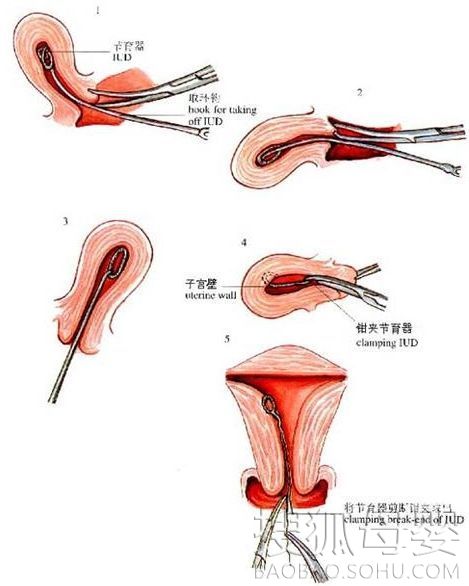 上环后的结构图