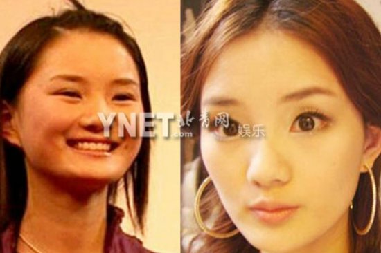 揭女星整容失败案例:郑爽李小璐变残 赵丽颖唐嫣死 ...