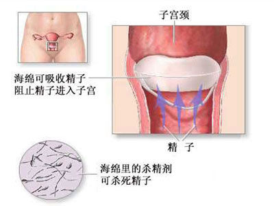 宫颈帽<em>海绵</em>塞 <em>女性</em>避孕全过程详细图解(组图)【