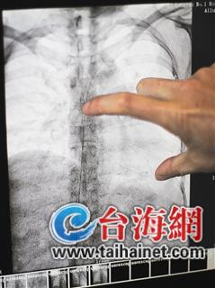 龙岩:植入静脉的输液管断了一截 12厘米导管漂