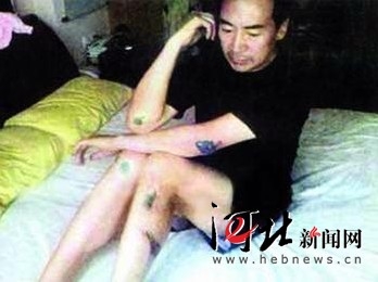 2006年7月寇振海被打多处骨折