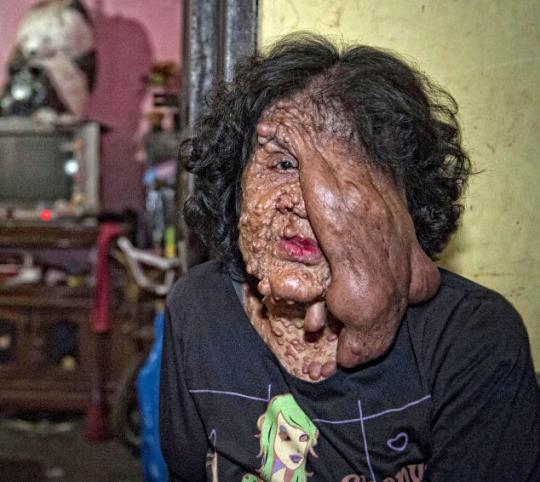 印尼一女子全身长数百肿瘤遭家人抛弃(图)【3】--陕西频道--人民网