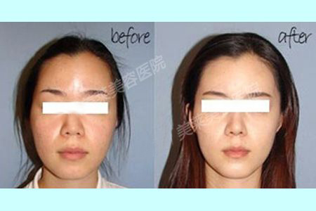 玻尿酸丰太阳穴 完美脸型只需一针
