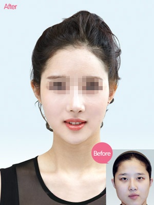 进行韩式隆鼻手术对年龄有限制吗?