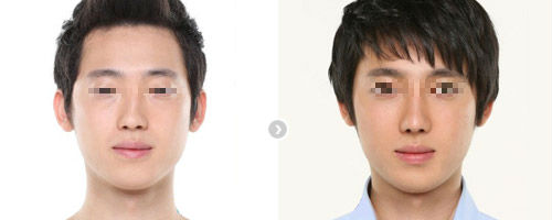 自体脂肪隆鼻多少钱 全方位剖析自体脂肪隆鼻