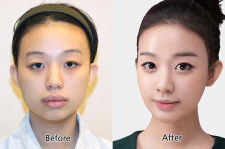 看我开眼角前后对比图 小眼瞬间变大