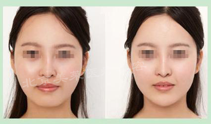 美莱垫下巴多少钱