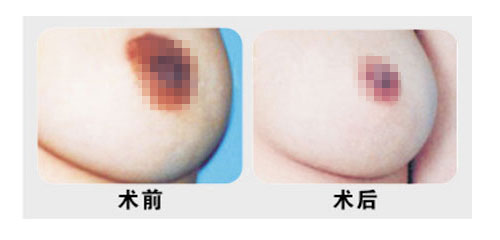 乳头缩小术有什么优点?