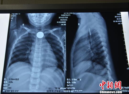 6岁女孩玩耍误吞硬币小物件或成伤害孩子“武器”