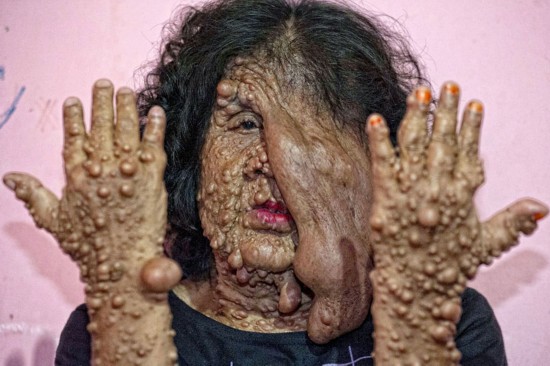 印尼泡泡皮肤女子被亲人抛弃 乞讨为生(图)