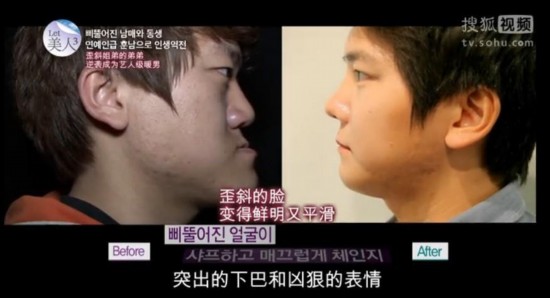 韩国双胞胎整形逆袭 丑女大变身