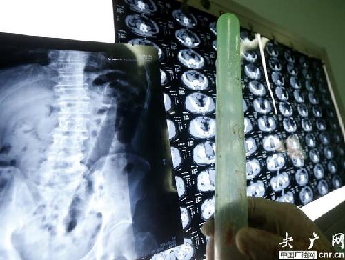 男子为寻刺激将20厘米塑料棒塞入肛门险致命