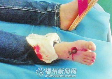 女子骑电动车逆行与电摩相撞 脚掌遭钢条穿透(图)