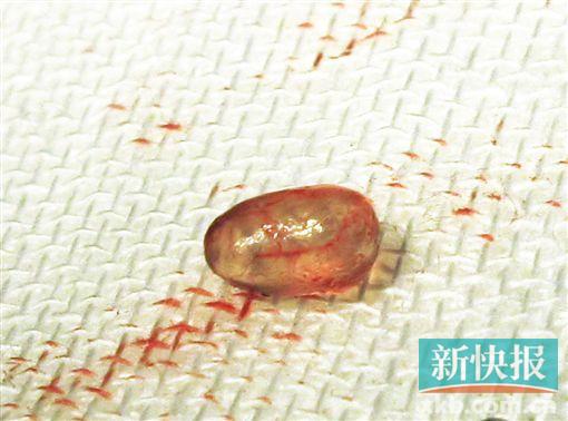 女子胸部长鱼卵被摘除 奥美定注射丰胸惹祸(