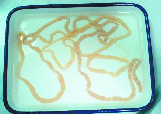 女子吃带血丝牛排 体内长出2.5米长绦虫(图)