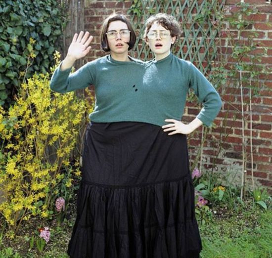 连体婴<em>姐妹</em>分离18年变美女 图揭连体人神秘生