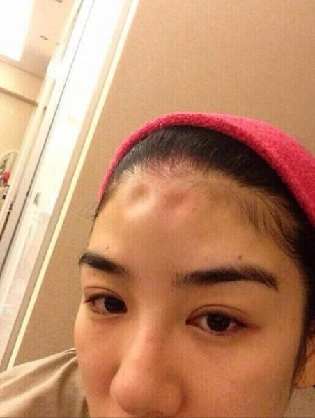 网友曝黄奕打玻尿酸现场照 自曝曾是医院员工