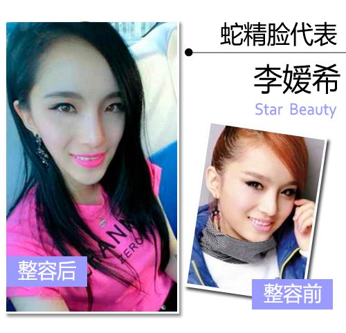 超女整容反变蛇精脸 揭不动刀v脸按摩操【3】