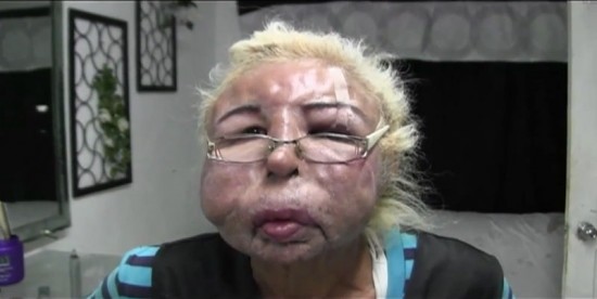 墨男子为追求精致面容脸部注射宝宝油致永久毁