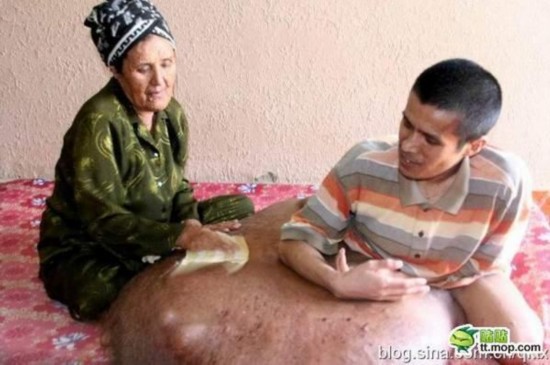 越男子基因突变 腿上长恐怖肿瘤