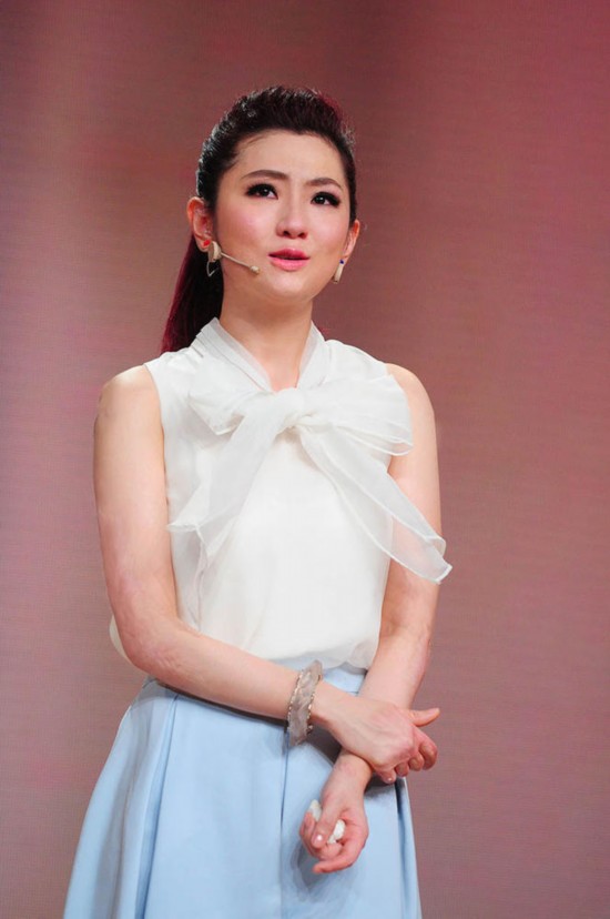 selina首度公开烧伤隐秘细节 勇敢展露惊悚伤疤