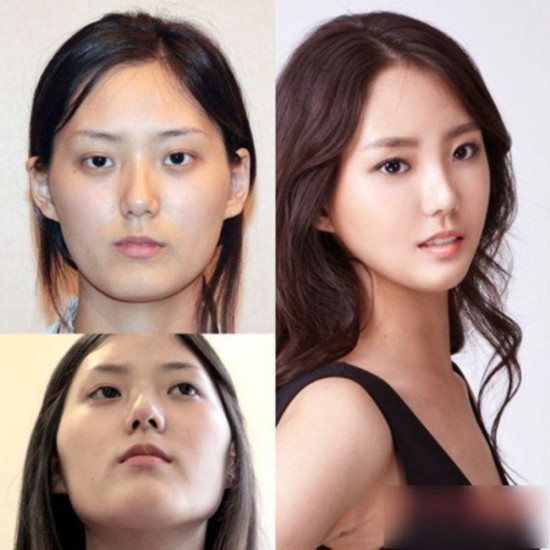 丑女变女神!图揭韩国震撼整容术