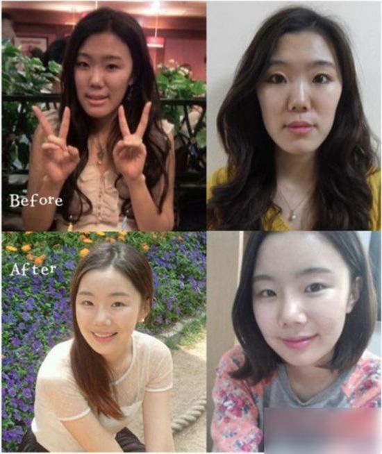 丑女变女神!图揭韩国震撼整容术