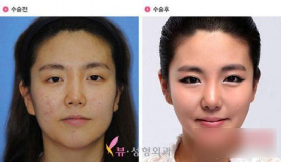 丑女变女神!图揭韩国震撼整容术