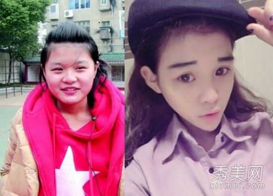 《变形计》主人公李耐阅 疑整容失败 失恋自残【6】