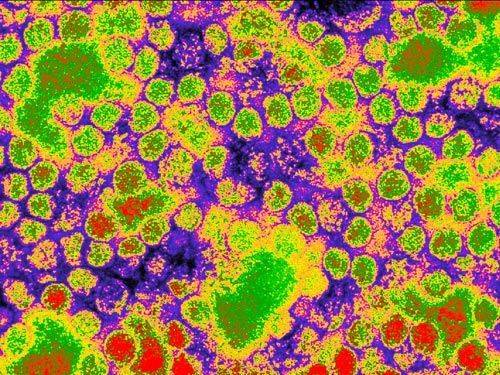 吃人肉细菌肆虐美国 致命微生物高清照【18