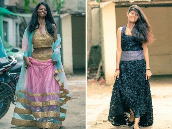 印度酸袭毁容女孩勇揭面纱拍写真