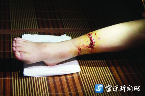 男童受伤小腿