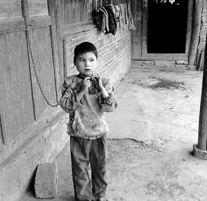 上海男孩患猫叫综合征 盘点世界最奇葩罕见病