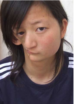 上海男孩患猫叫综合征 盘点世界最奇葩罕见病