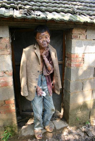 上海男孩患猫叫综合征 盘点世界最奇葩罕见病