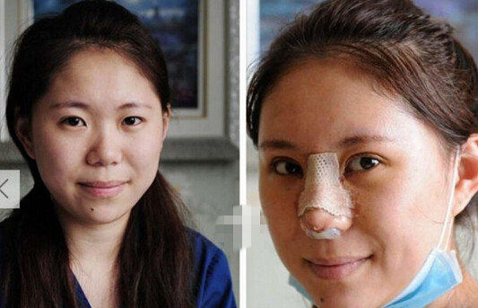 25岁青岛女孩直播手术整容 欲整成韩国美女脸【5】--山东频道--人民网