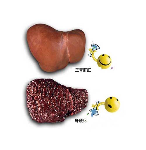 【肝硬化