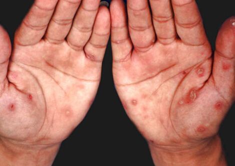 女子性病未愈继续卖淫获刑6个月 性病早期症状