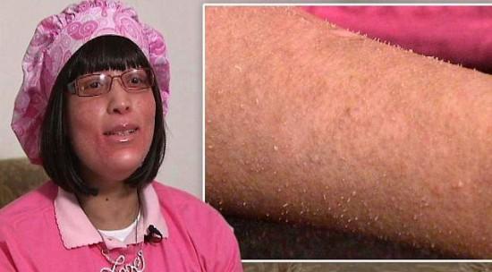 美37岁女子身患怪病 :皮肤上不长汗毛长指甲