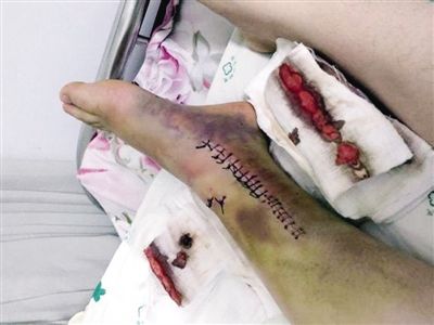 初中生被老师罚做百个蹲起 致脚踝骨折或残疾