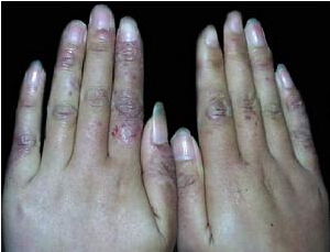 冻疮是冬天的常见病,冻疮是由于寒冷引起的局限性炎症损害,尤其是手