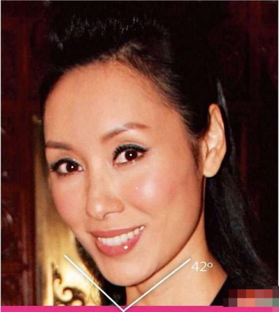 打玻尿酸开双眼皮都弱爆了 揭为变锥子脸不要