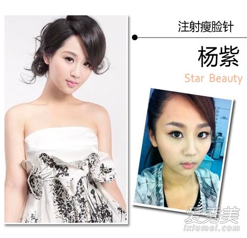 杨紫打瘦脸针微整形？揭开90后女星整容机密